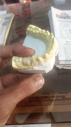 lower right side first mular Crown cap quality check