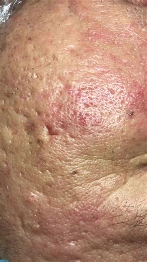 Effective Pore Extraction Techniques for Clear Skin