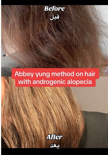 abbey yung method on hair with androgenic alopecia #androgenicalopecia #abbeyyungmethod #bondrepair #minoxidil #dhtblocker
