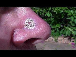 Removing a BCC Skin cancer with Radiotherapy