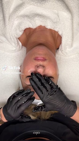 Let me introduce you to one of my favorite treatments — the Green Sea Peel. This is a natural spicule peel made from marine ingredients that work to stimulate the skin’s renewal process from within. Unlike traditional chemical peels that dissolve the top layer of skin, the Green Sea Peel uses tiny spicules that penetrate the skin and trigger collagen production and cell turnover. This treatment is amazing for improving acne, acne scars, pigmentation, uneven texture, and enlarged pores. It helps 