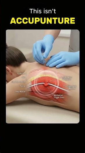 Dry Needling Explained 💉 Muscle Knots Gone Instantly? Trigger Point Therapy Truth!