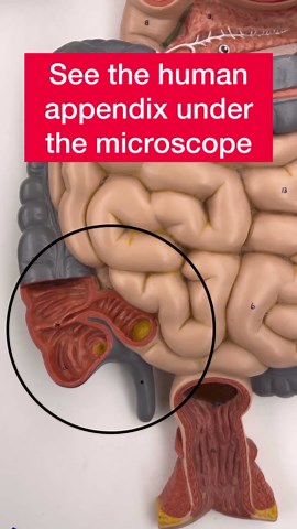 Adolfo Sánchez-Blanco, PhD🇪🇸🇺🇸 on Instagram: "The appendix, a tiny organ that is part of the large intestine, can sometimes become inflamed (appendicitis). If left untreated, an inflamed appendix can lead to serious complications. For example, an inflamed appendix can end up rupturing and if this happens, bacteria from the appendix can infect the lining of the abdominal cavity (peritonitis). Peritonitis can quickly lead to sepsis and therefore death due to organ failure. . The function of th