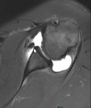 Shoulder MRI Scan - Inferior Shoulder Dislocation