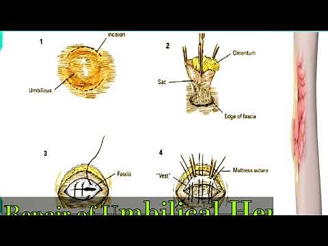 Hernia repair surgery- umbilical hernia