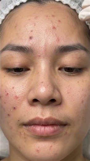 Squeezing Out Blackheads & Numerous Pimples — Deep Skin Extraction! 😱✨
