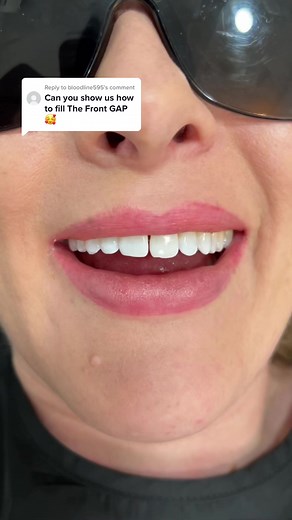 Composite Bonding for Teeth Gap Closure and Alignment | Dr Danya