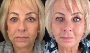 Cosmetic surgery: Doctor reveals cost of a botox 'eye lift'