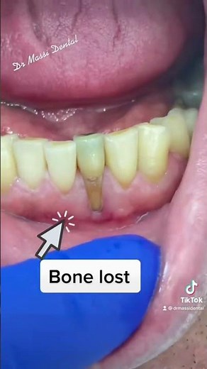 Bone Loss , Gum Receding