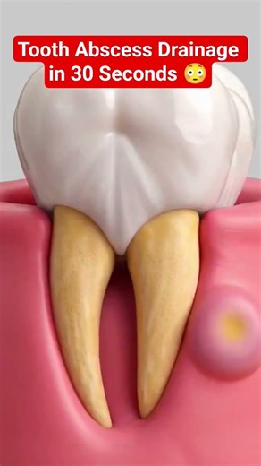 Tooth Abscess Drainage in 30 Seconds 😳#toothabscess#dentalanimation#satisfying#dentistry#tooththerap