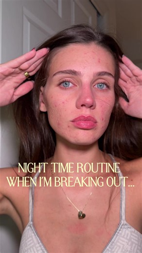 My Skin Hated New Skincare: Back to My Original Routine for Acne