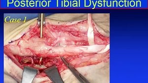 Case Discussions: Treatment of Posterior Tibial Tendon Dysfunction