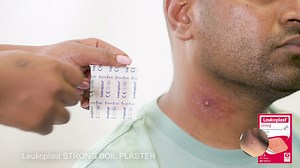 Leukoplast strong boil plaster with its small breathable hole is uniquely designed for boils. These plasters come in a pack of 3 and should be replaced daily. Leukoplast gives your hospital solutions to use at home. https://www.leukoplast.co.za/leukoplast-home.html #ApplicationLeukoplast | Leukoplast South Africa