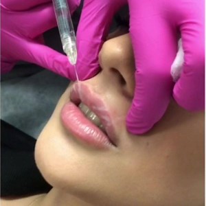 BTS Lip Enhancement 💉 This injection technique is know as "Tenting" by augmenting the lip with controlled vertical threads.� This advanced lip technique provides optimal control over both shape and volume 👄 | BeautyFULL Cosmetic Medical Clinic