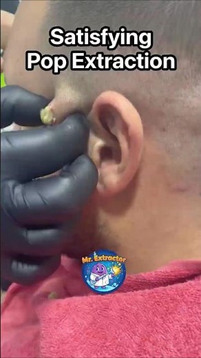 Satisfying Pop Extraction Behind the Ear | Extreme Release!