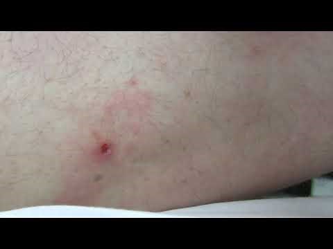 Removing head of a tick and cleaning the wound