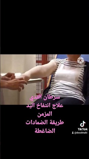 سرطان الثدي-علاج انتفاخ اليد المزمن-طريقة الضمادات الضاغطة