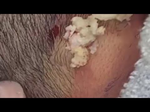 Deep blackhead Removal 2026, acne removal spa, big pimple 2026, #acne #pimple #cyst