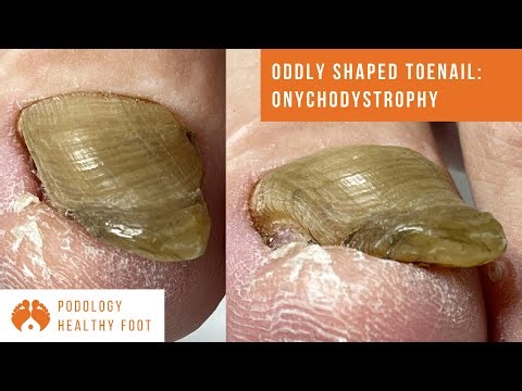 Oddly shaped toenail: onychodystrophy due to longstanding and very severe trauma to the toenail*asmr
