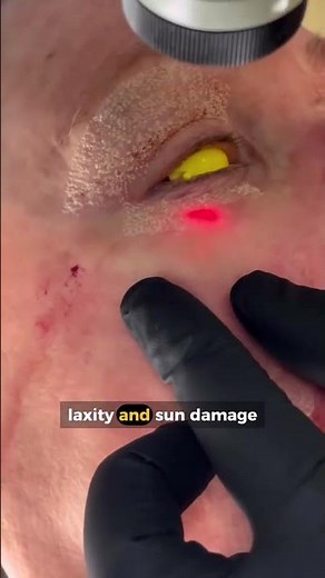 How Fractional Laser Resurfacing Improves Uneven Skin Texture