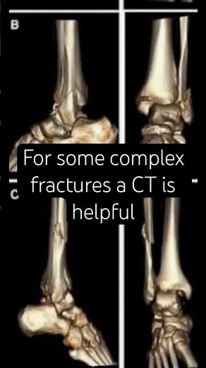 Ankle Fractures 101 #hospital #anatomy #doctor #science #foot