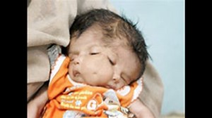 Baby with 2 faces born in north India