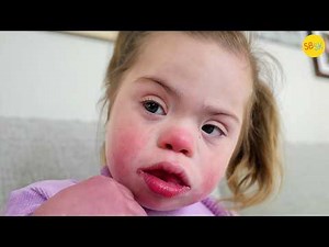 She Has Childhood Alzheimer’s and Down Syndrome
