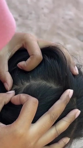 Dicas para lidar com piolhos e picuinhas de forma relaxante