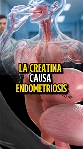 LA CREATINA CAUSA ENDOMETRIOSIS… 🤔🧪 La endometriosis es una enfermedad ginecológica caracterizada por la presencia de tejido endometrio-like fuera del útero 🩸🧬. Es una patología inflamatoria crónica 🔥, asociada a dolor pélvico 😖, sangrado menstrual abundante 🩸📉 y alteraciones de la fertilidad 👶⚠️. En este contexto, un estudio mecanístico publicado en 2024 📚🔬 ha sido citado afirmando que “la creatina promueve la endometriosis al inducir resistencia a la ferroptosis” ⚠️🧠. Sin embargo, 