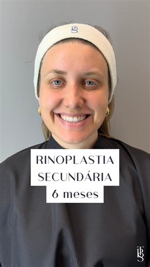 Dʀ. Mᴀʀᴄᴇʟᴏ Tᴀʙᴏsᴀ - Rinoplastia on Instagram: "Rinoplastia feminina secundária - 6 meses de um sonho realizado ✨👃🏻 - Indicações terapêuticas: alterações anatômicas que causem queixas estéticas, funcionais e doenças relacionadas à via respiratória. Fatores que influenciam: cirurgias nasais prévias, uso de substâncias ilícitas no nariz, tabagismo, ácido hialurônico, PMMA ou outros materiais sintéticos, tipo de pele, cuidados no pós-operatório, repouso, uso de medicamentos prescritos e seguiment