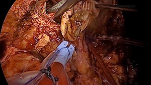 Redo aortic root surgery with Homograft for prosthetic valve endocarditis