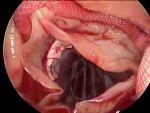 Open Heart Valve Surgery Mini Aortic Valve Replacement  • Video • MEDtube.net