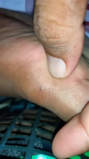 42K views · 162 reactions | Look at this 勞 | Pimple Popping | Facebook