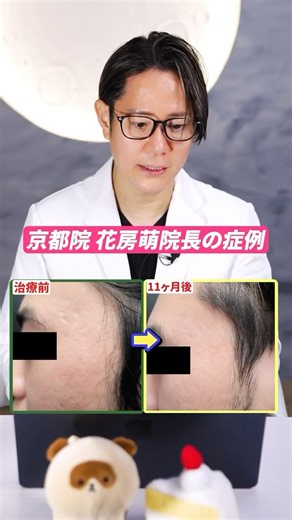 This is a case study of the Hanafusa method of acne scar treatment at Hanafusa Dermatology Clinic...