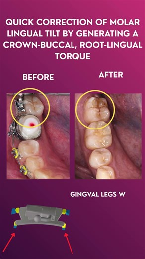 Use Of BaTR Buccal Tube in Severe Disto-Buccal Molar Rotation