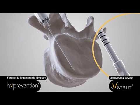 Hyprevention: V STRUT Operative Technique USA