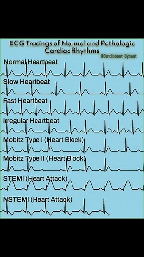 326K views · 1.4K reactions | ✨ ECG Interpretation: Normal and Pathological Rhythms #ECG #EKG #Cardiology #MedEd #CardiacRhythms #HeartHealthRepost | Abdallah Othman | Facebook