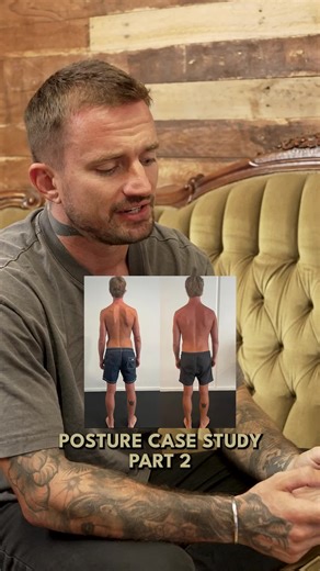 In part 2, we look at what was actually driving the restriction and how it was corrected. The shoulder blades were sitting too far back and downwardly rotated, creating winging and locking up the neck. The pelvis was also stuck in anterior tilt, which pulled the ribcage and shoulders back and made cervical flexion almost impossible. The fix wasn’t one muscle or one stretch. It was correcting shoulder blade mechanics, restoring upward rotation, strengthening the right push patterns, and addressin