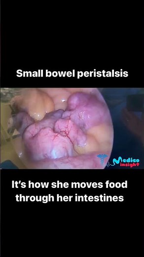 Small Bowel Peristalsis | Peristalsis | Bowel Movement | Bowel | Small Intestine