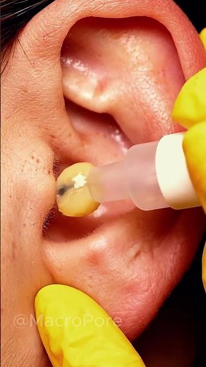 One Perfect Vacuum Pull on an Ear Comedone 👀