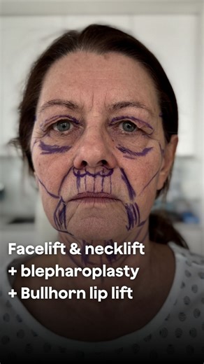 93K views · 1.3K reactions | ✅ Deep plane facelift ✅ Deep necklift ✅ Upper blepharoplasty ✅ Lower blepharoplasty ✅ Bullhorn lip lift ⏰ 2 weeks after surgery  Age 67 years  Under local anesthesia combined with analgosedation V-CLINIC - Brno, Czech republic ‍⚕️ @tomasventruba | V-Clinic | Facebook