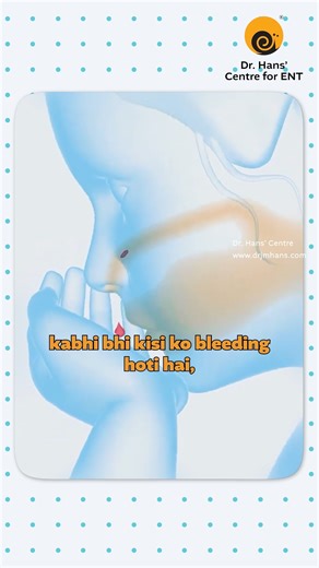 A nosebleed can feel alarming, but it’s usually manageable when you know the right steps. Follow the simple guidelines mentioned in the reel to control the bleeding safely and avoid common mistakes. If your nosebleeds are frequent or difficult to stop, it’s essential to consult an ENT specialist. For personalised care and the right treatment, visit Dr. Hans’ Centre for ENT or book your consultation today. Follow us for more useful ENT tips and guidance. #drhanscentre #drhanscentreforent #entcons