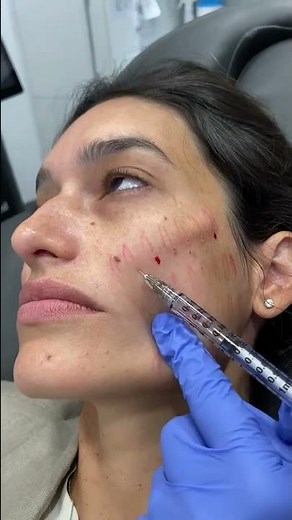 Sculptra treatment for collagen boosting | Dr. Medispa