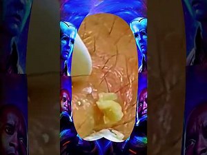 Blackheads Removal | Acne Treatment and Very Satisfying Satisfying Pimple pop #blackheads