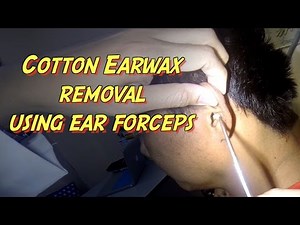 Cotton Earwax Removal using Ear Forceps