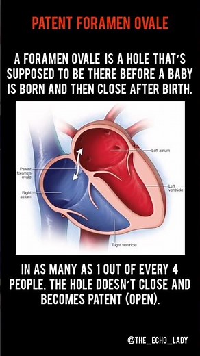 ASD or PFO? 👇🏻🫀🤔 #cardiology #healthcare #medical #echocardiogram
