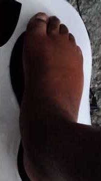 My recovery from dropfoot update Got motion although not hard and strong but I feel tall and proud!