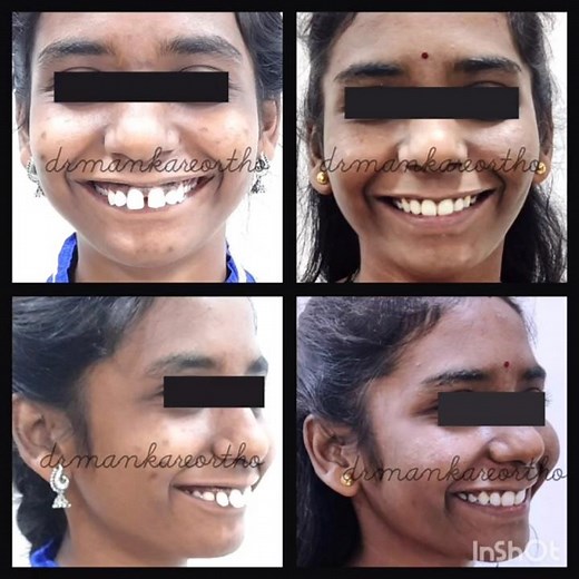 Orthodontic camouflage with severe class 2 div 1 malocclusion with TAD:s!