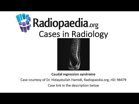 Caudal regression syndrome (Radiopaedia.org) Cases in Radiology