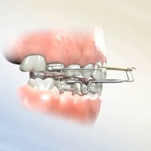 Orthodontic Mentor Pro on Instagram: "@drbraces_ The Tandem Appliance is designed for orthopedic correction of the growing Class III patient. The appliance design is more comfortable than conventional devices because it is worn intraorally. This fact greatly increases the rate of compliance when compared to the facemask variety of Class III correctors. . Additionally, the traditional facemask variety protrudes the maxilla with pure extra oral anchorage with minimal dentoalveolar changes, whereas